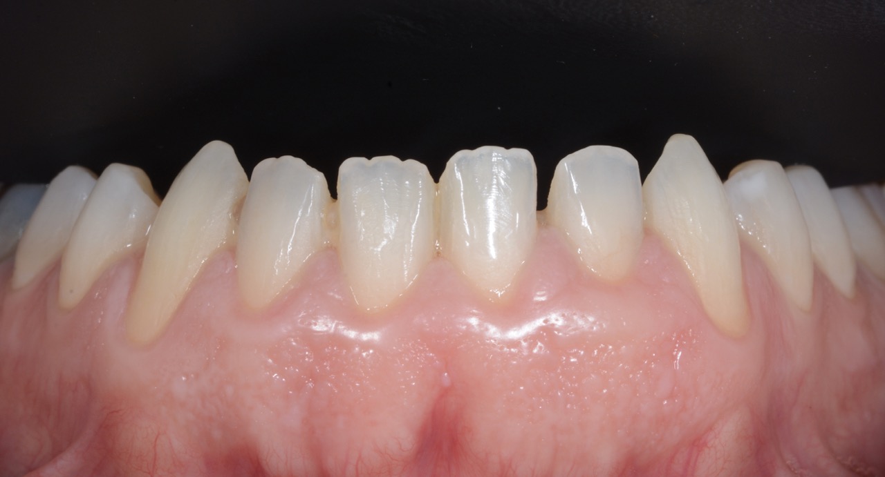 Primo piano dei denti di Francesco prima del trattamento