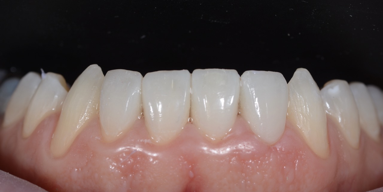 Primo piano dei denti di Francesco dopo il trattamento